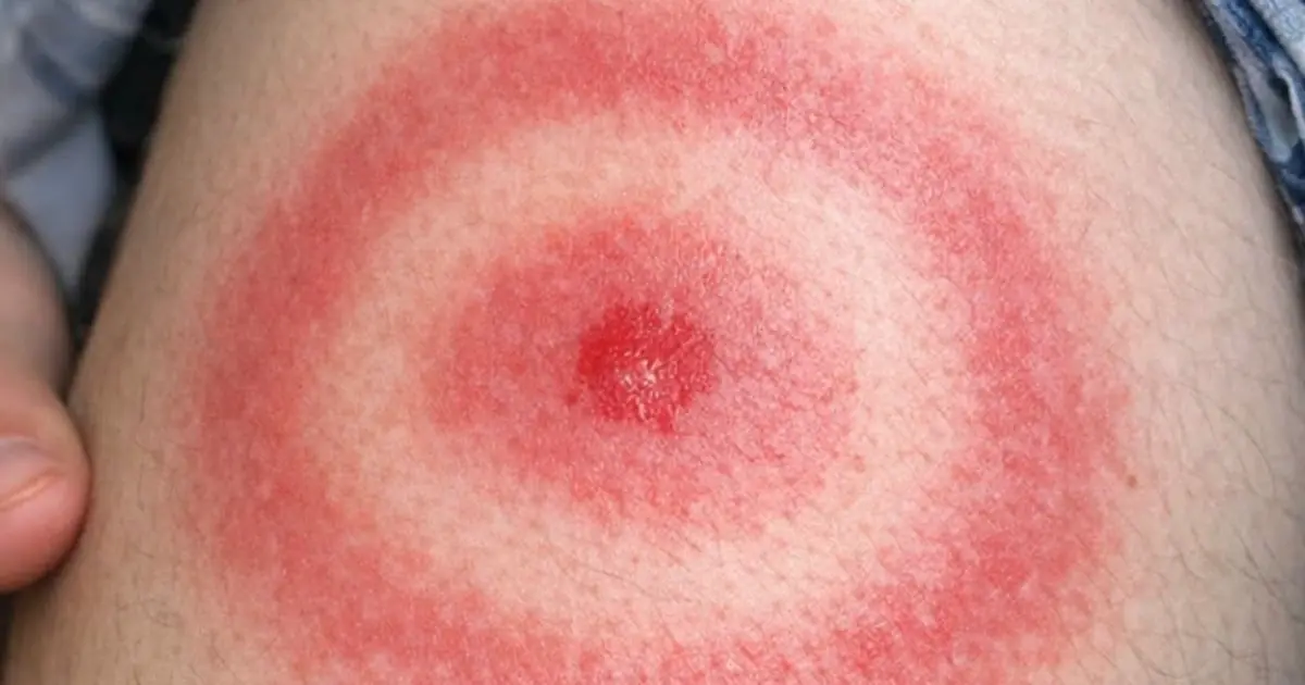 My teenage son woke up with this expanding red ring that looks like a bullseye on his leg. We are hours from urgent care right now. Is this serious?