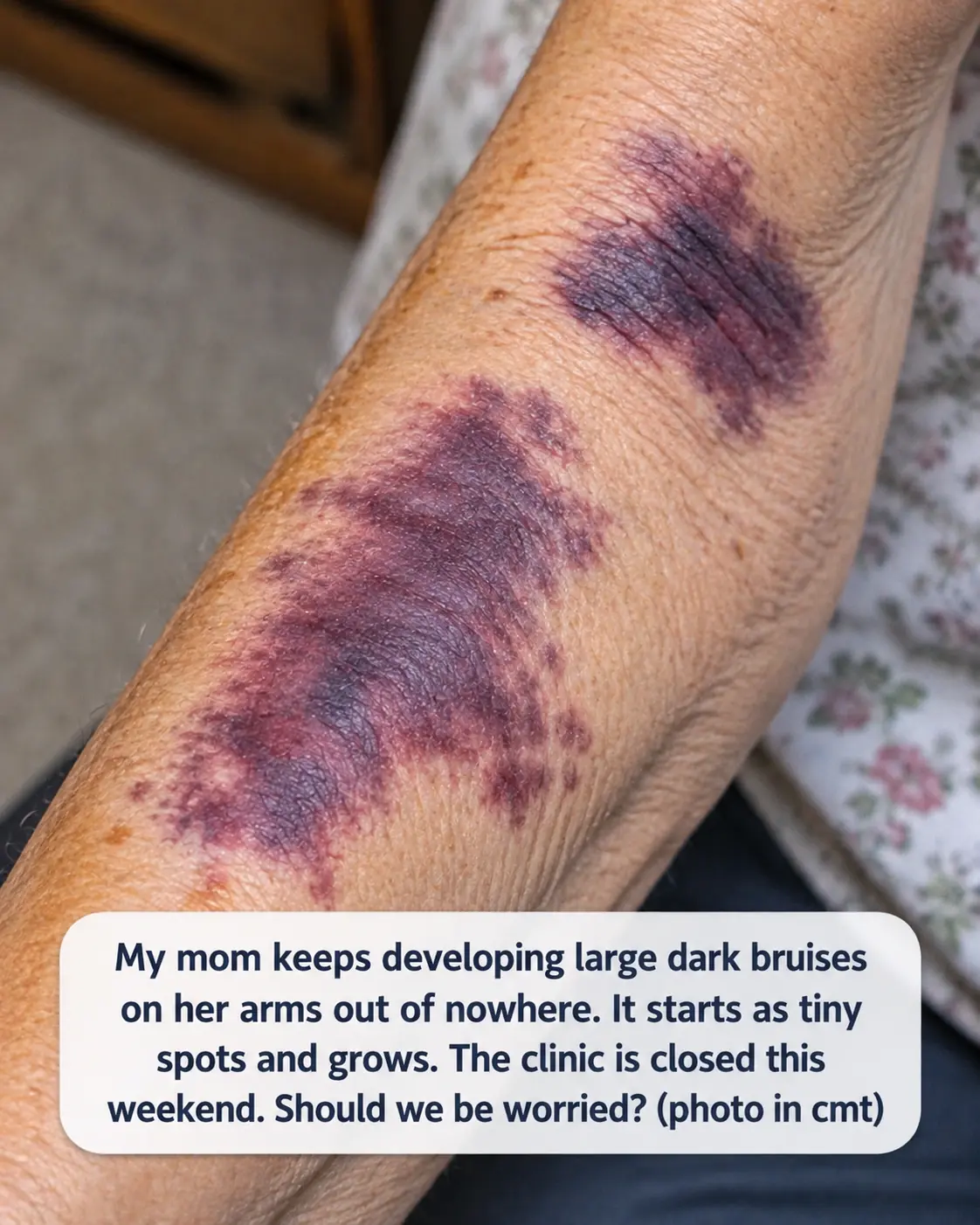 Mom keeps getting these huge dark purple patches on her forearms from the smallest bump. The clinic is closed for the weekend. Is this serious?