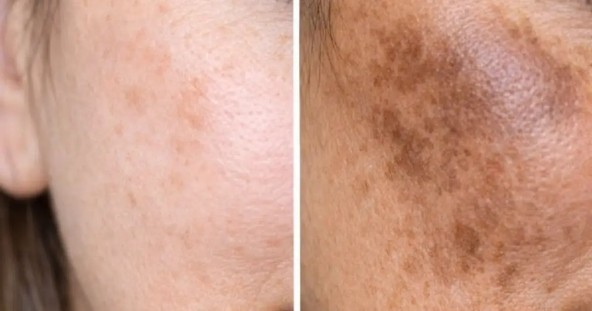 Rub this 1 mixture on your cheeks and get rid of dark patches, uneven skin tone, and melasma. Full article 👇 💬