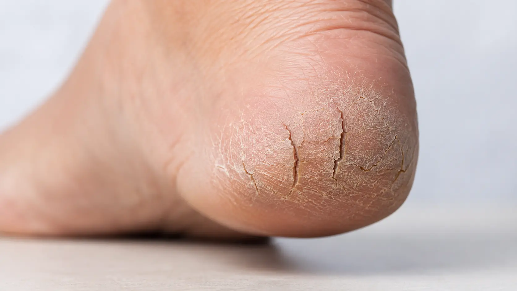 Cracked Heels? This Simple Overnight Routine May Help Soften Them Fast