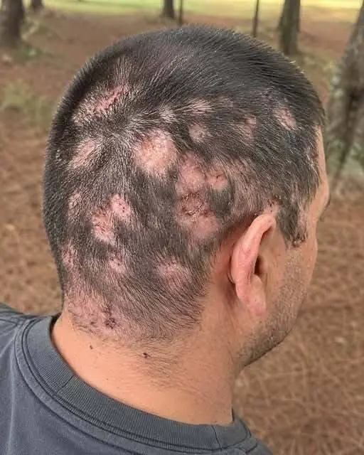 Here are the first symptoms after contact with…