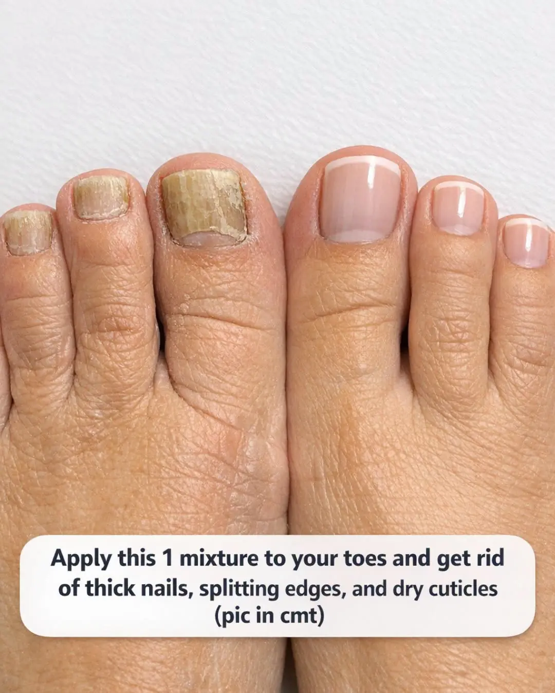 Apply this 1 mixture to your toes and get rid of thick nails, splitting edges, and dry cuticles
