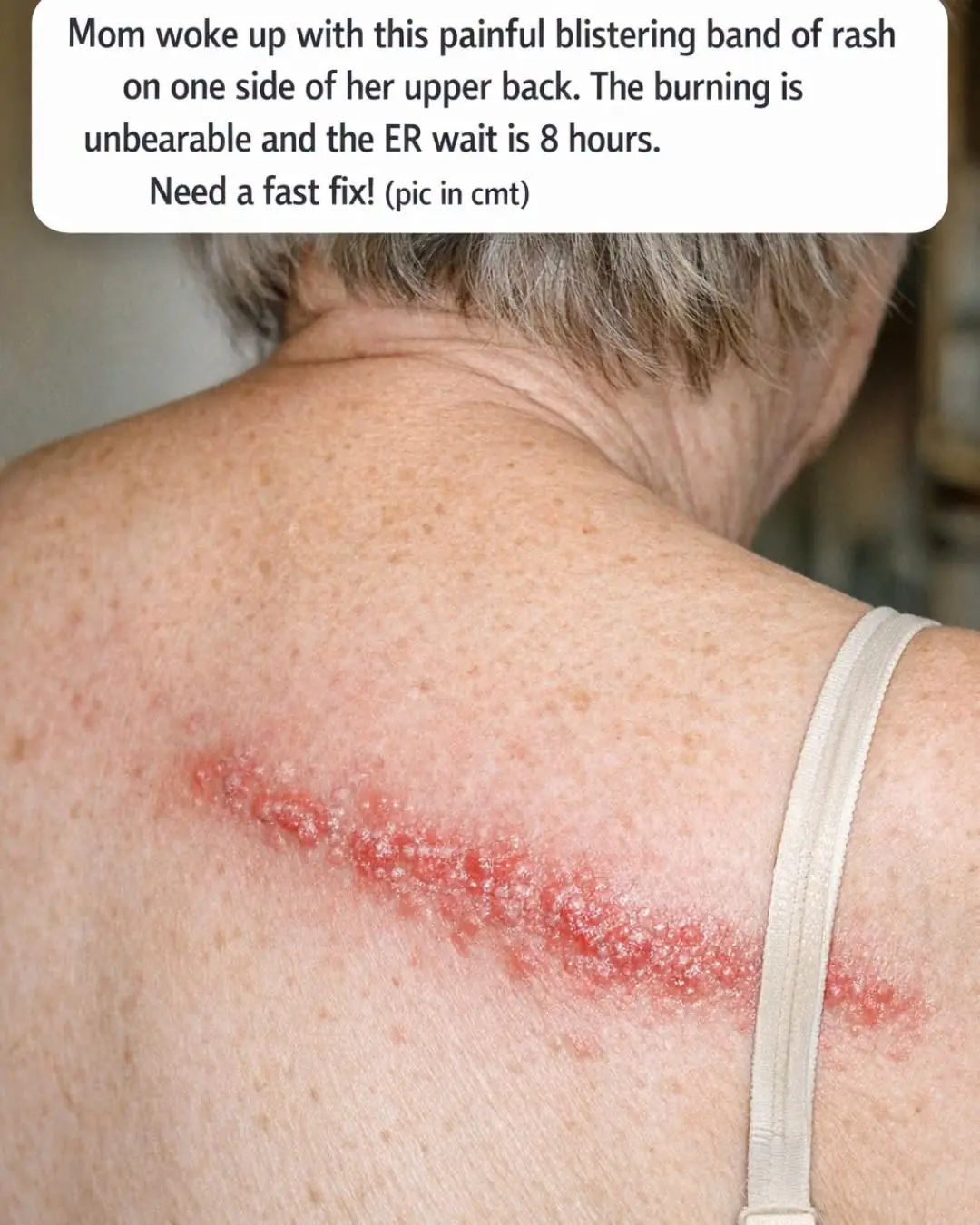 Mom woke up with this painful blistering band of rash on one side of her upper back. The burning is unbearable and the ER wait is 8 hours. Need a fast fix!