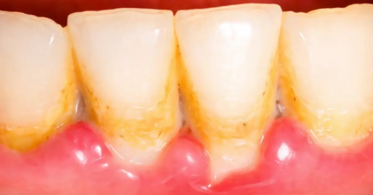 How to Remove Dental Plaque Naturally (Evidence Based)