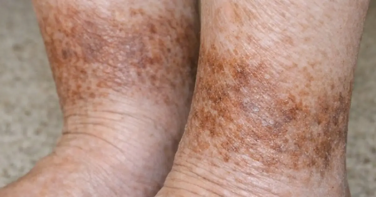 My grandmother keeps getting this rusty brown, scaly discoloration wrapping around her lower legs and ankles. The nurse line is busy. Is this serious?