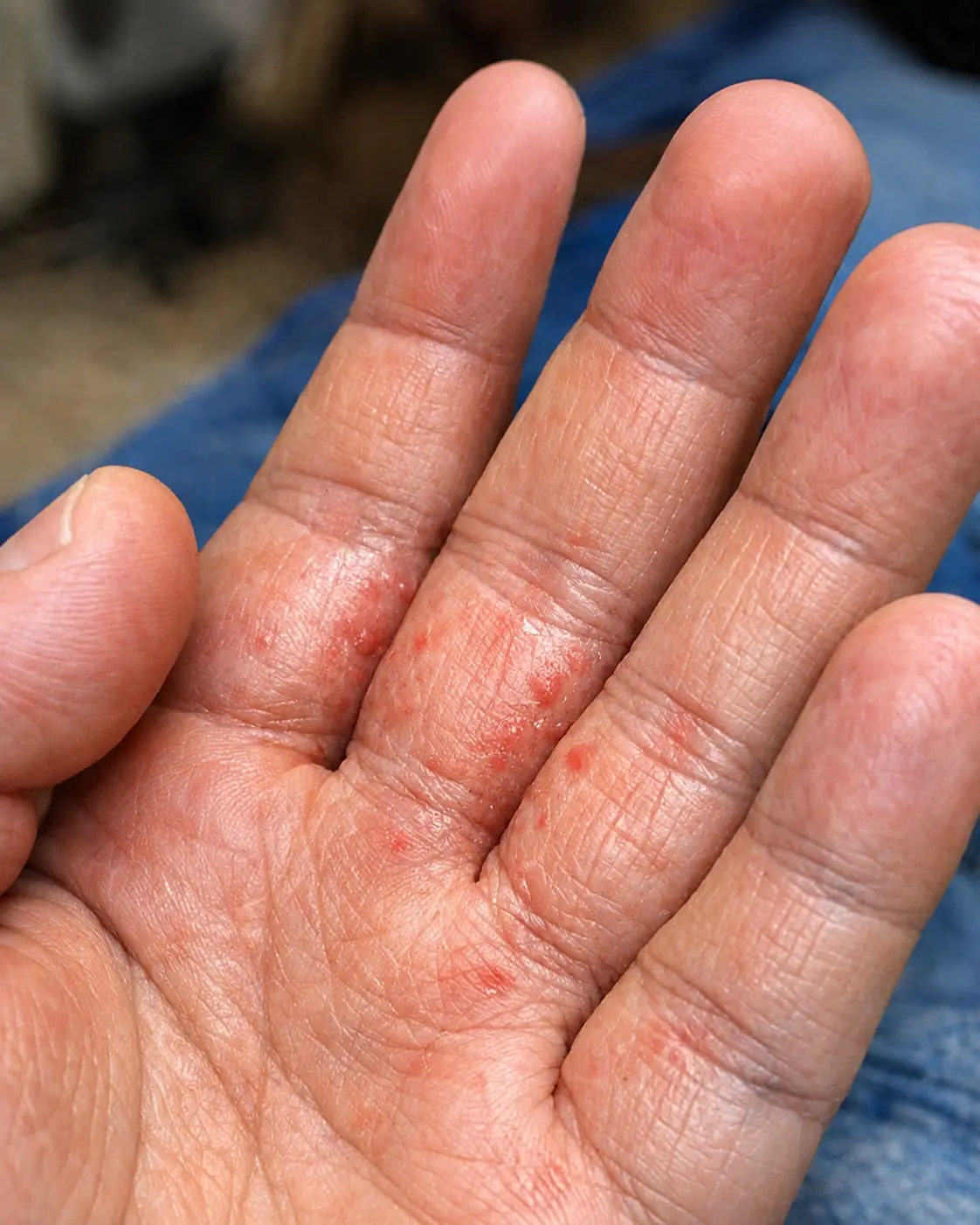 Tiny Red Bumps Between Your Fingers and Intense Itching? It Could Be Scabies