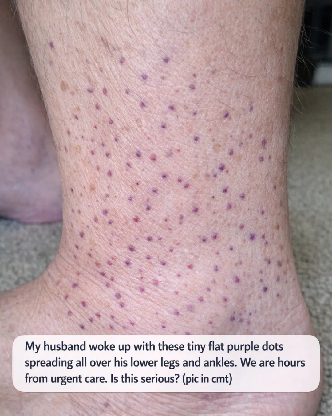 My husband woke up with these tiny flat purple dots spreading all over his lower legs and ankles. We are hours from urgent care. Is this serious?