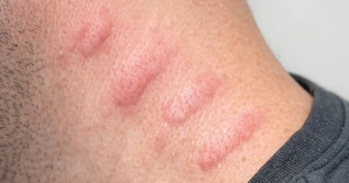 My husband woke up with these raised pale red welts spreading across his neck and arms. We are hours from urgent care right now. What can we do?