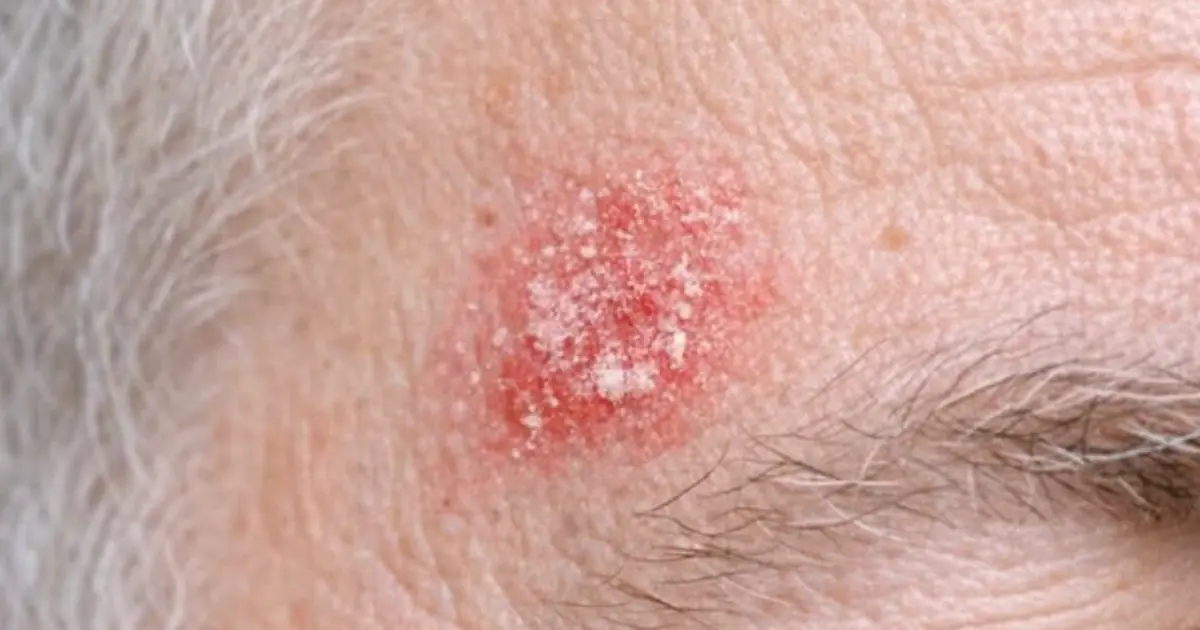 My husband keeps getting this rough, scaly red patch on his temple that feels like sandpaper. The clinic is closed for the weekend. Is this serious?