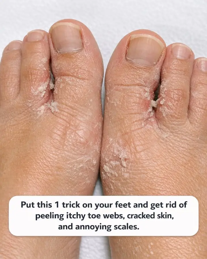 Put this 1 trick on your feet and get rid of peeling itchy toe webs, cracked skin, and annoying scales.
