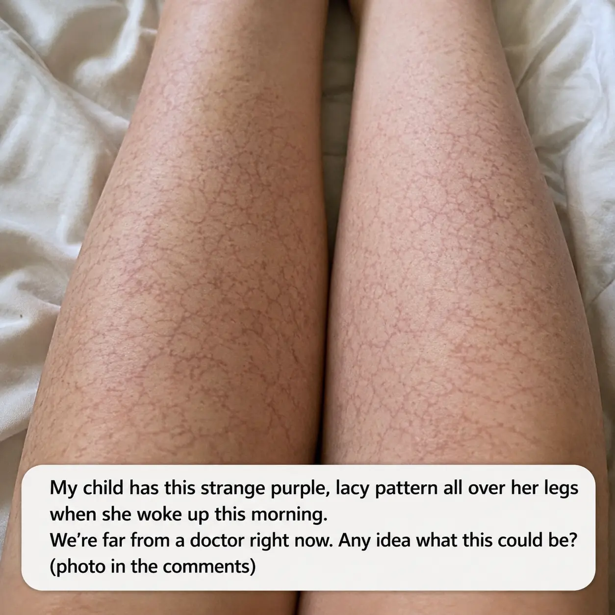 My daughter woke up with this mottled, purplish, lace-like pattern covering both her legs. We are hours from urgent care right now. What is this?