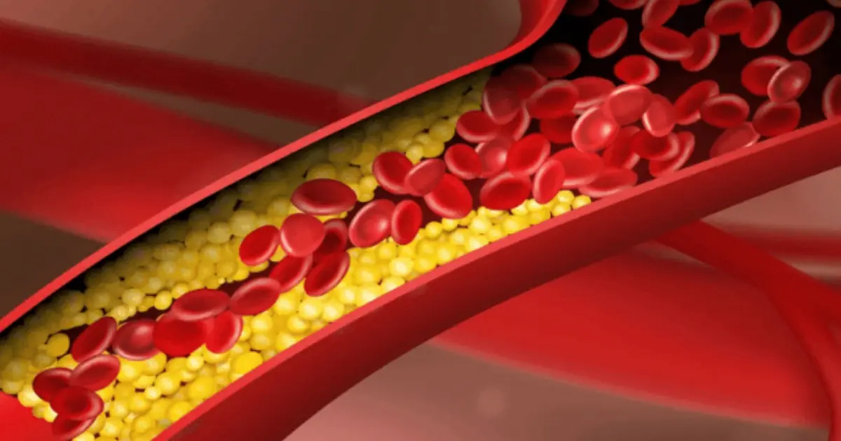 Dangerous calcium could be building up in your arteries — these 6 vitamins help stop it