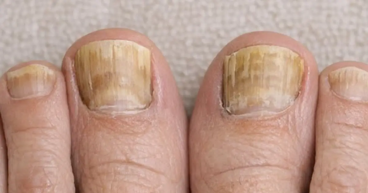 Soak your toenails in this 1 solution and get rid of yellow buildup, dark spots, and thick ridges