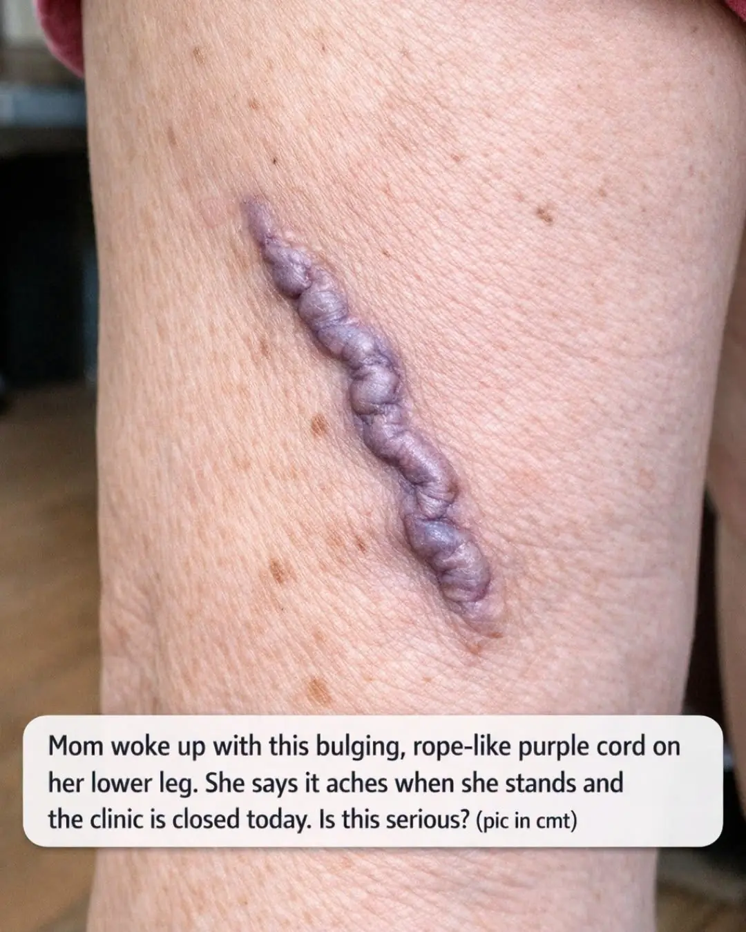 Mom woke up with this bulging, rope-like purple cord on her lower leg. She says it aches when she stands and the clinic is closed today. Is this serious?
