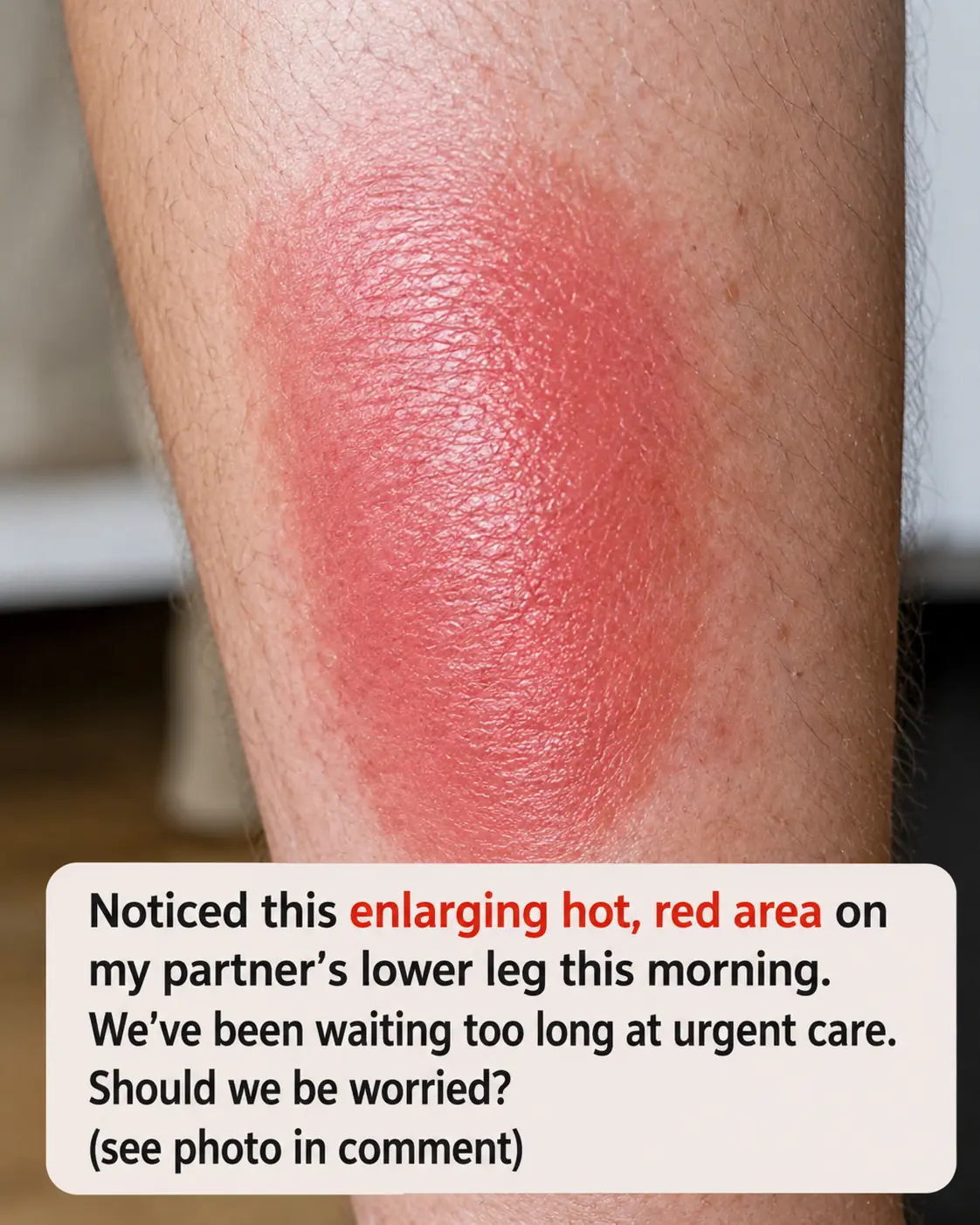 My husband woke up with this spreading hot red swollen patch on his lower leg. We are hours from urgent care and the nurse line is busy. Is this serious?