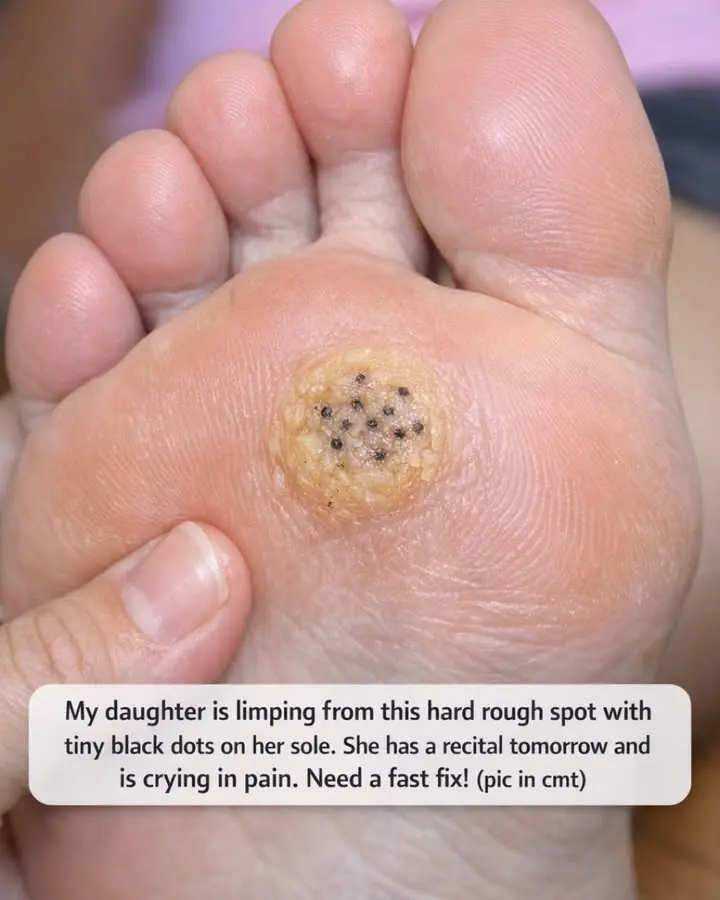 My daughter is limping from this hard rough spot with tiny black dots on her sole. She has a recital tomorrow and is crying in pain. Need a fast fix!