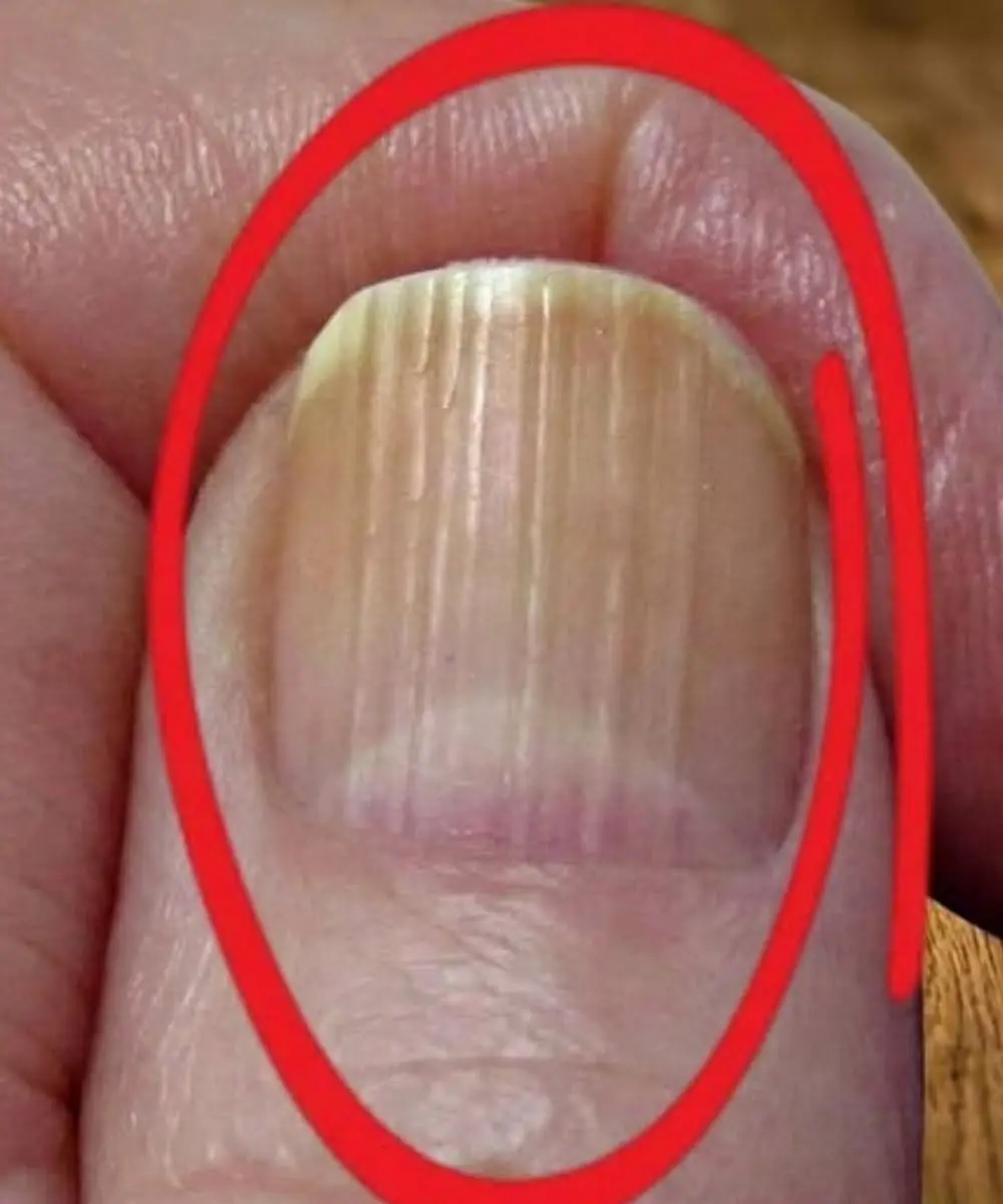Vertical Lines on Your Nails