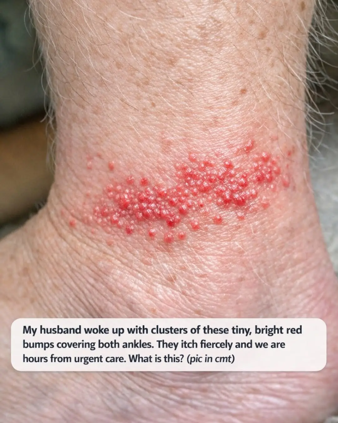 My husband woke up with clusters of these tiny, bright red bumps covering both ankles. They itch fiercely and we are hours from urgent care. What is this?