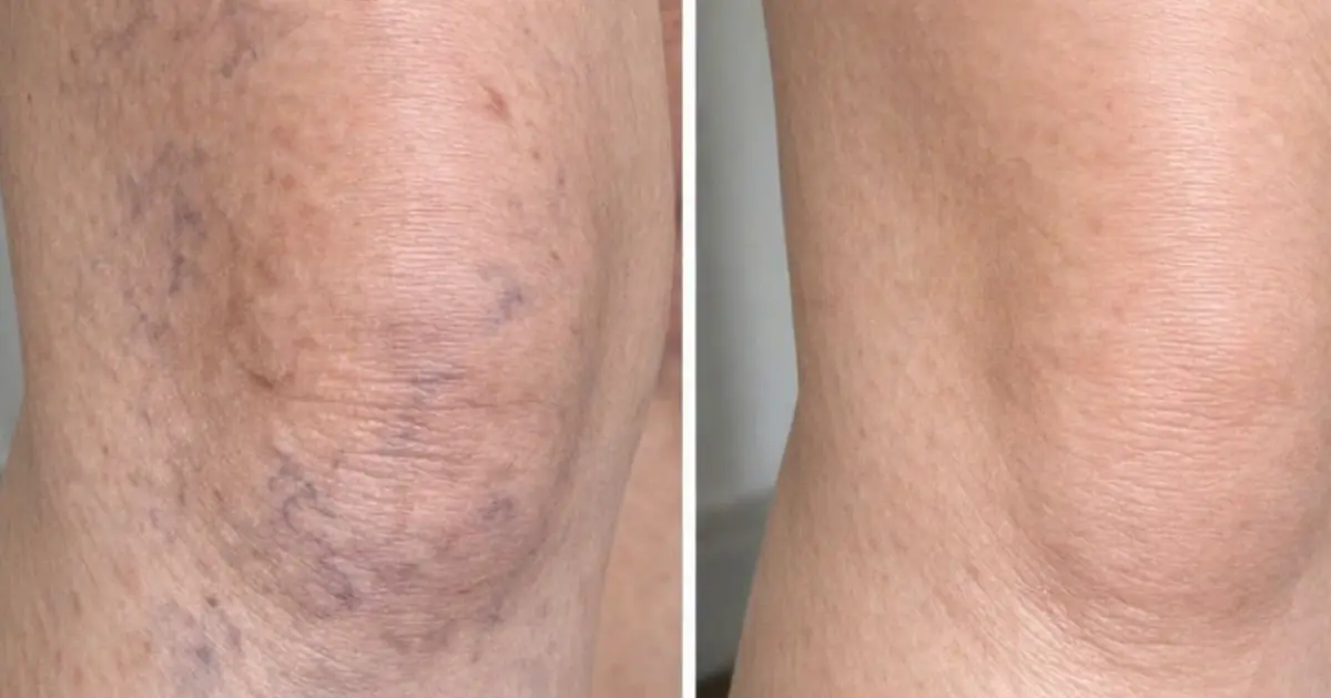 Rub this 1 solution on your legs and get rid of veiny patches, purple spots, uneven tone