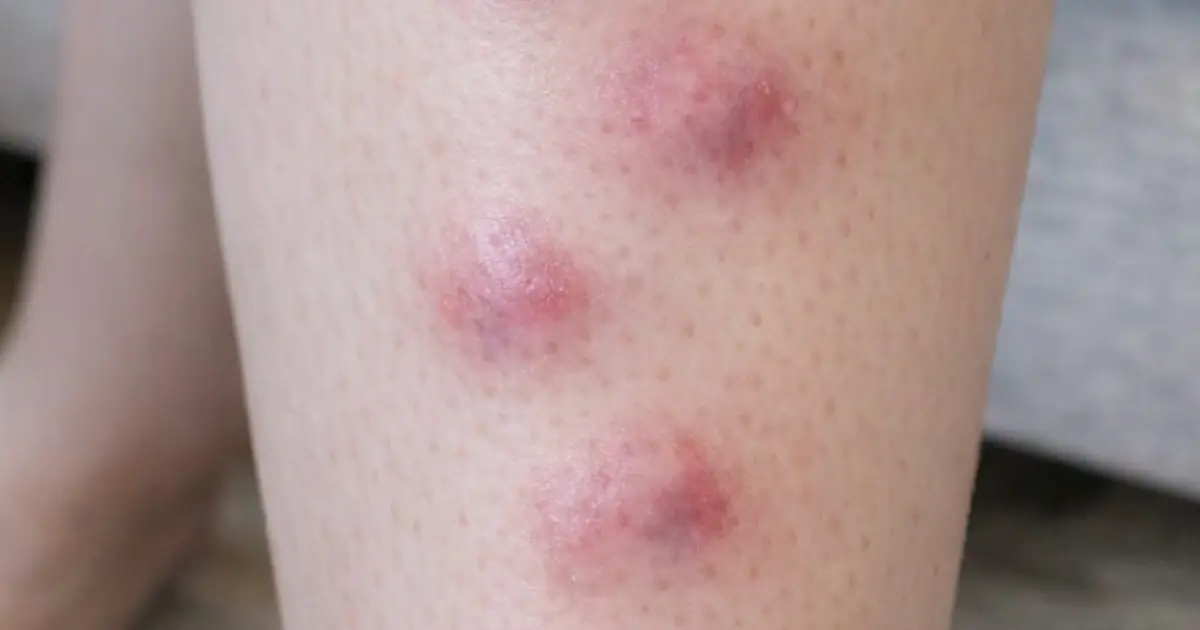 My daughter woke up with these lumpy, bruised-looking red patches down the front of her shins. The clinic is closed today. Is this serious?