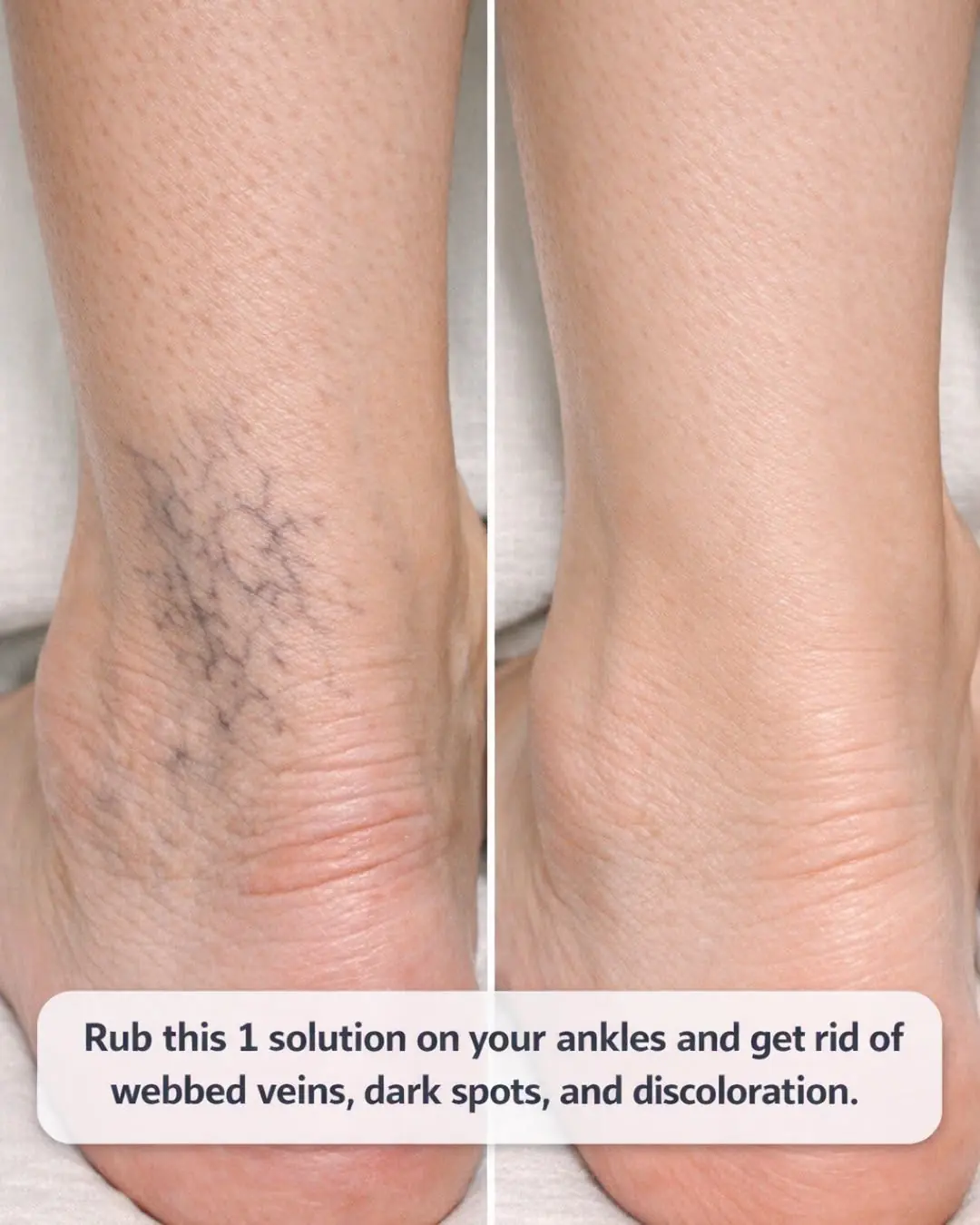 Rub this 1 solution on your ankles and get rid of webbed veins, dark spots, and discoloration.