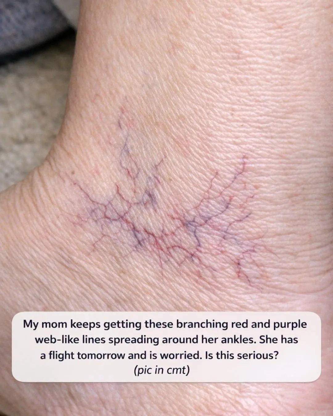 My mom keeps getting these branching red and purple web-like lines spreading around her ankles. She has a flight tomorrow and is worried. Is this serious?
