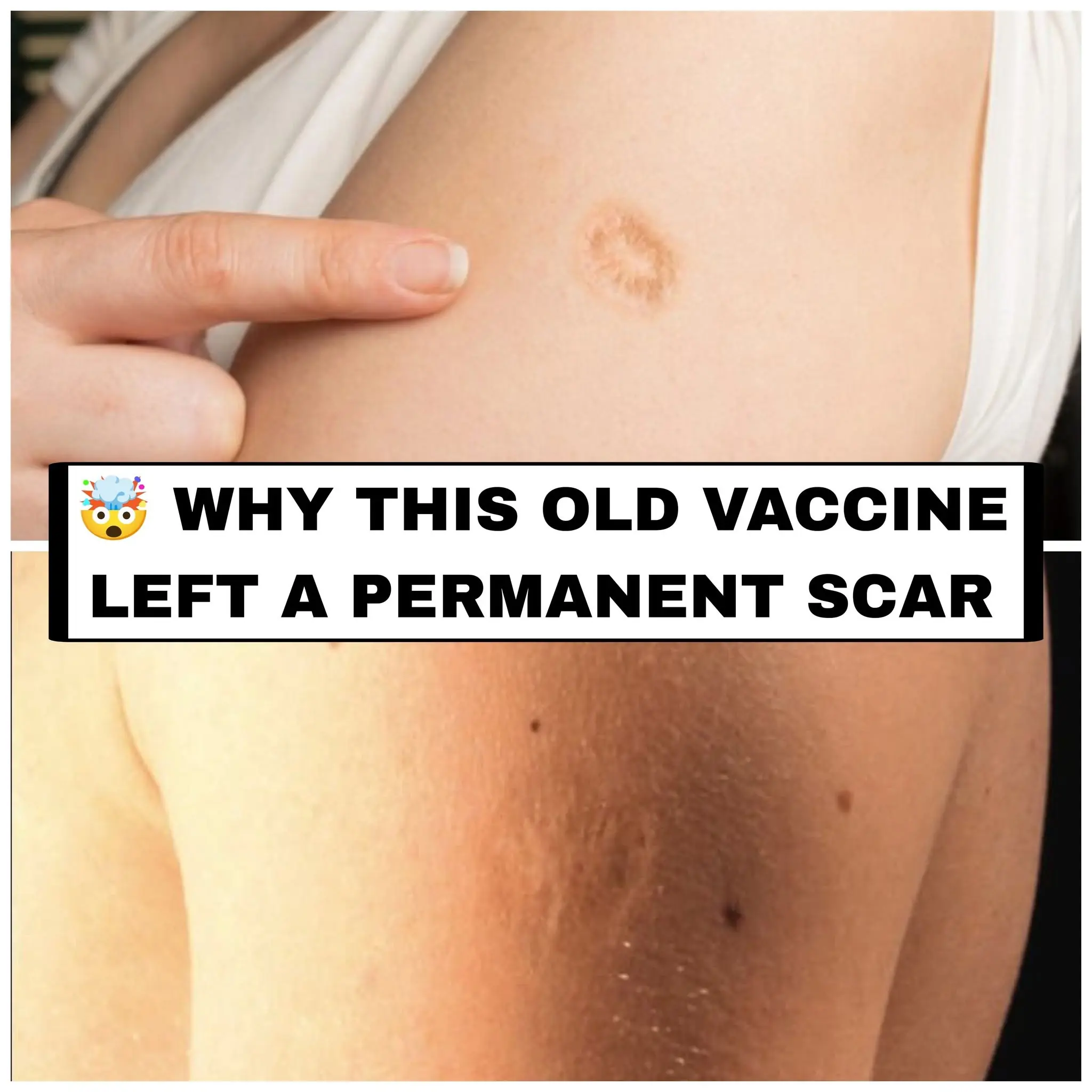 Smallpox Vaccine Scars Explained: What They Look Like and Why They Form