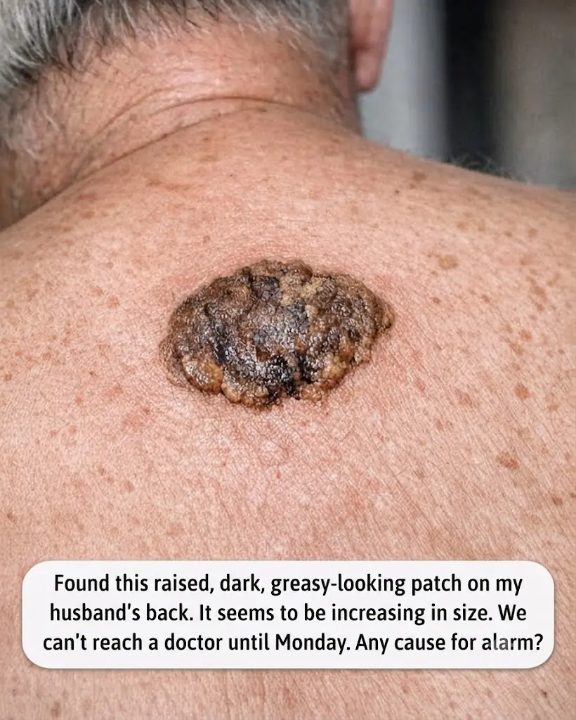 My husband has this crusty waxy brown patch that looks stuck on his back and is slowly growing. We are hours from urgent care. Is this serious?