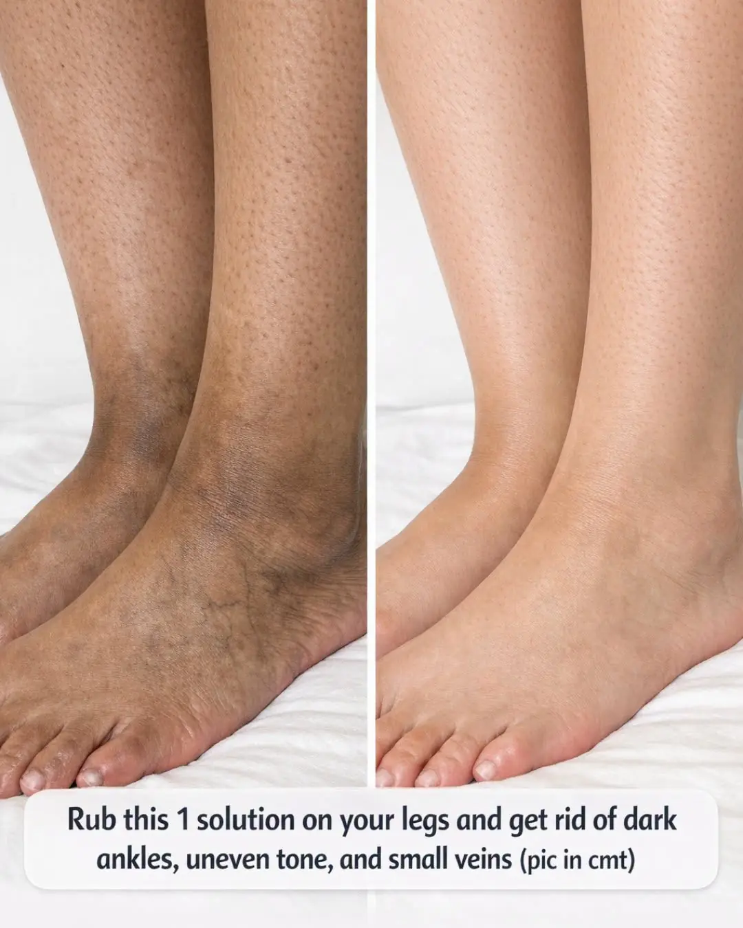 Rub this 1 solution on your legs and get rid of dark ankles, uneven tone, and small veins