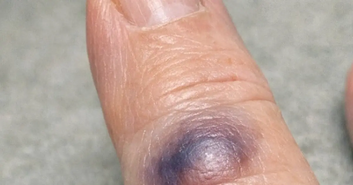 Mom woke up with this sudden dark purple bruise bulging under her finger. She says it stings, but the clinic is closed today. Is this serious?