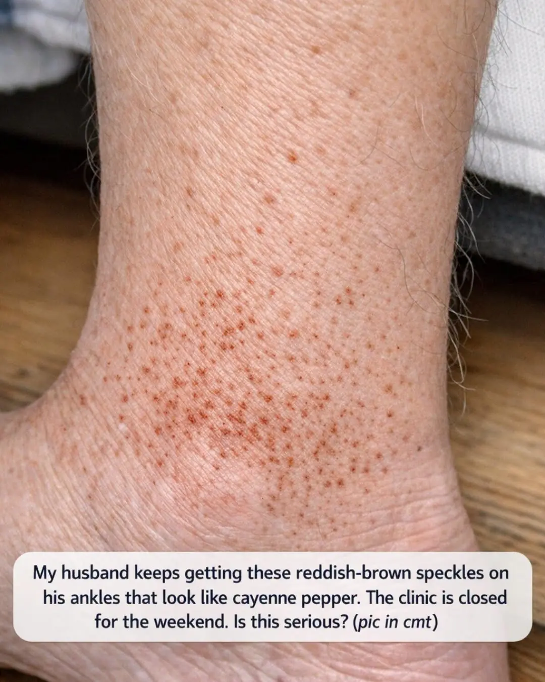 My husband keeps getting these reddish-brown speckles on his ankles that look like cayenne pepper. The clinic is closed for the weekend. Is this serious?. Full article 👇 💬