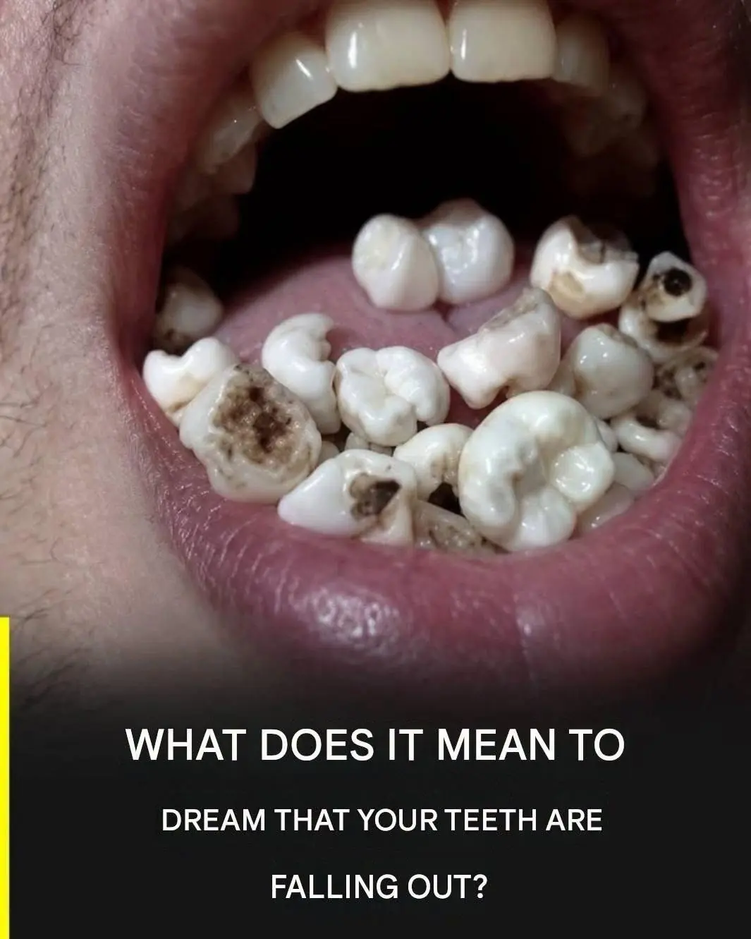 What Does It Mean to Dream About Your Teeth Falling Out