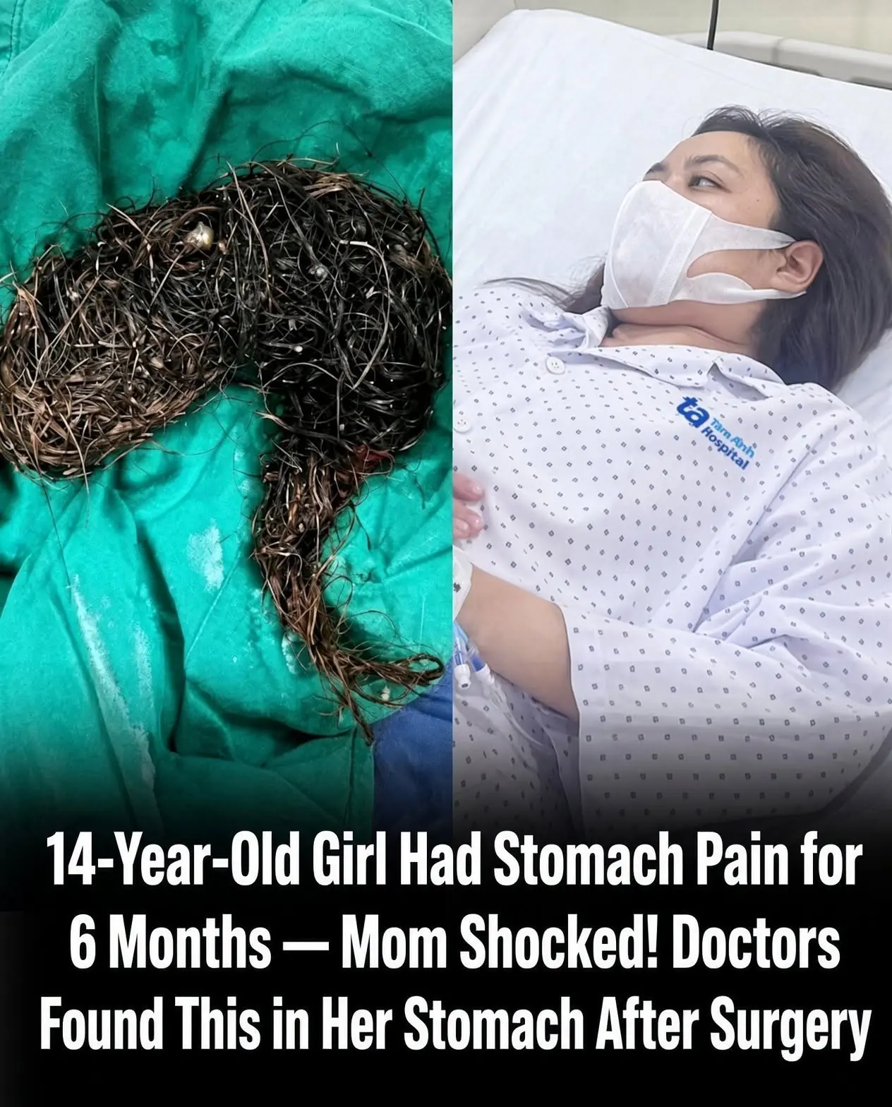 A 14-Year-Old Girl Suffered Stomach Pain for Months—What Doctors Found