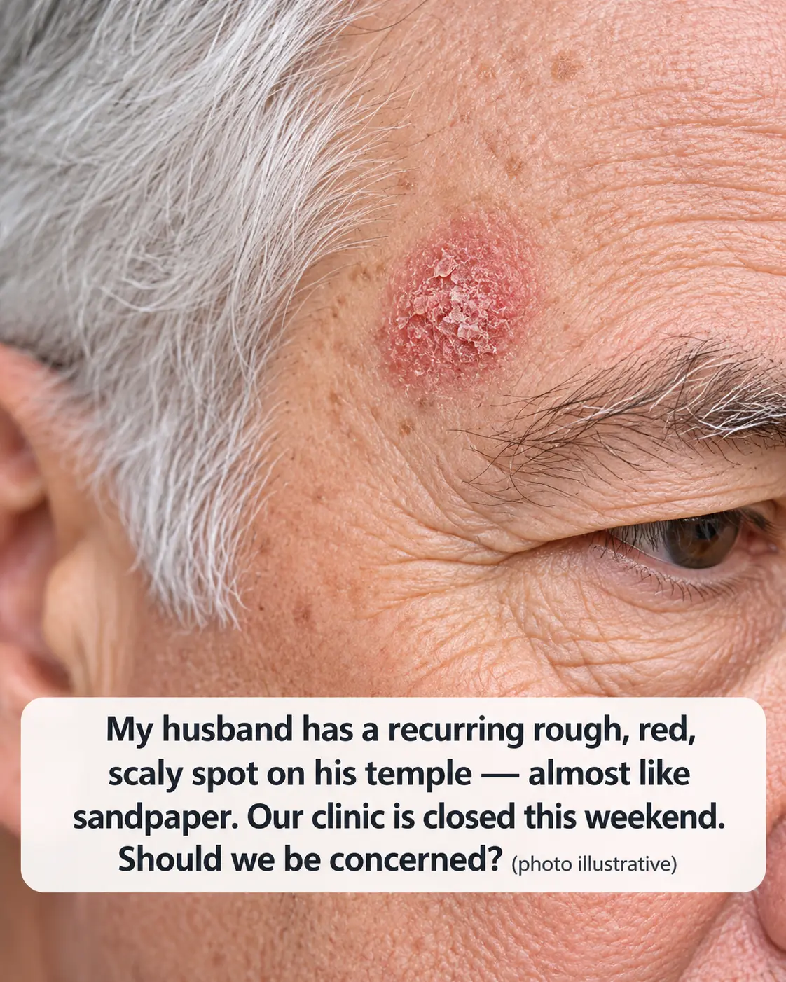 My husband has a recurring red, rough, scaly patch on his temple that feels like sandpaper. The clinic is closed for the weekend, and I’m worried. Could it be something serious?