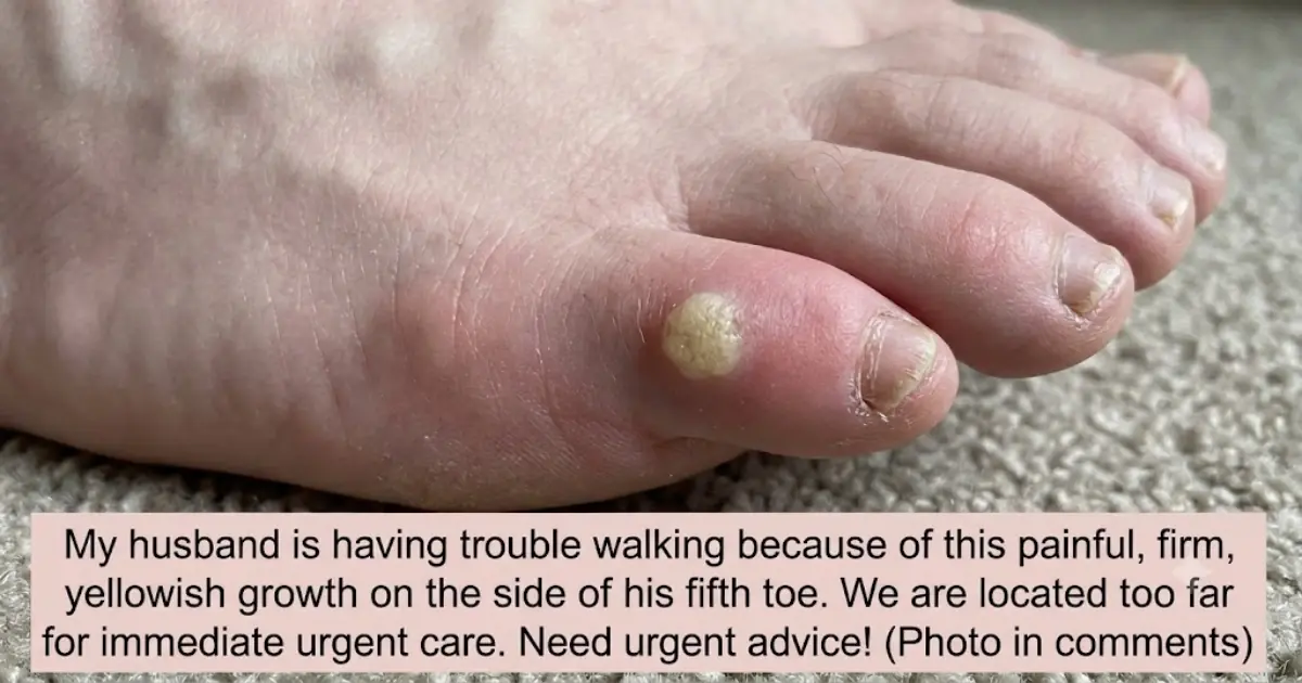 My husband is limping from this hard raised yellowish bump on the side of his pinky toe. We are hours from urgent care and he can barely walk. Need a fast fix!