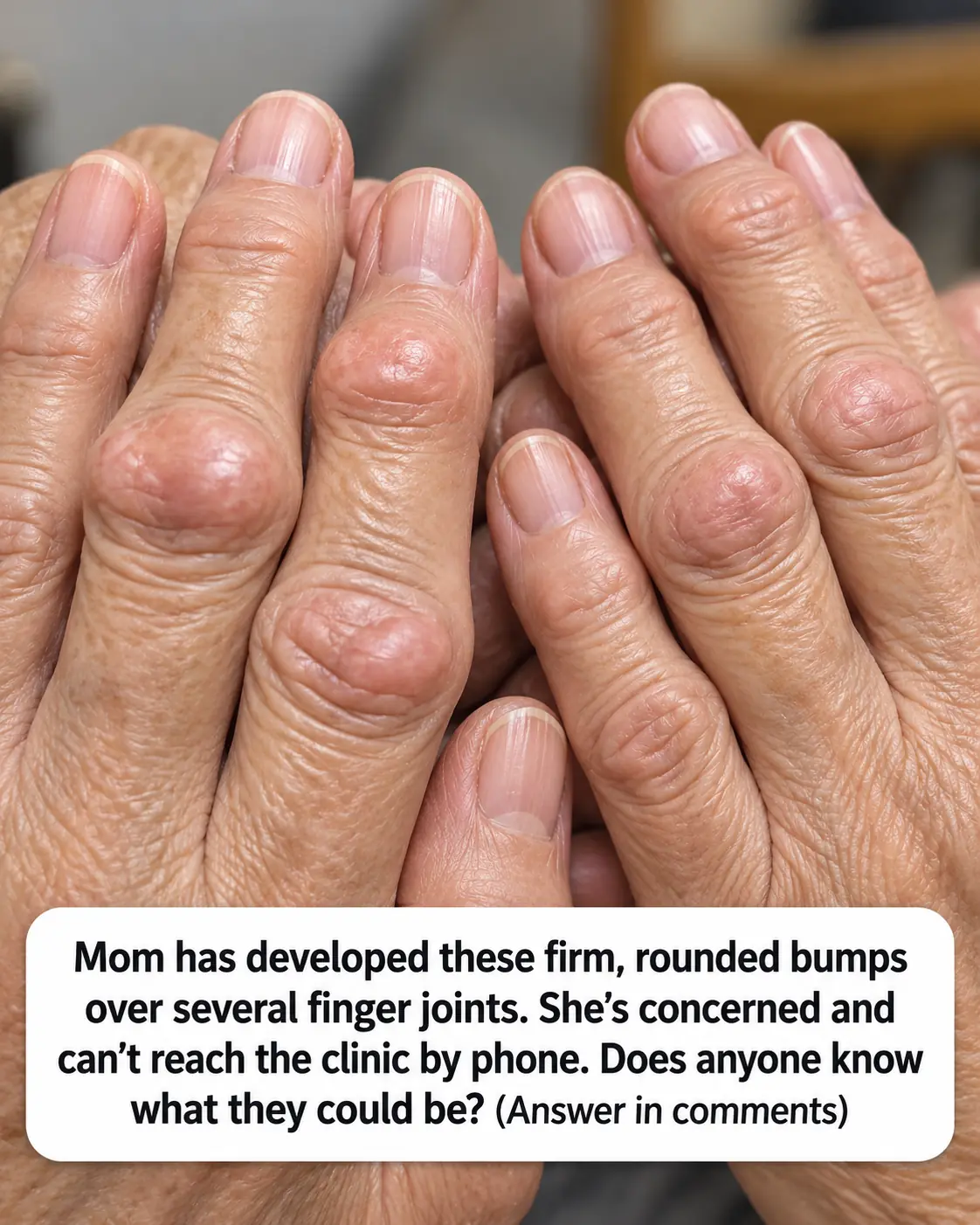 Mom has developed thick, fleshy, rounded bumps right over her knuckle joints. The nurse hotline is busy, and she’s getting worried. What could this be?