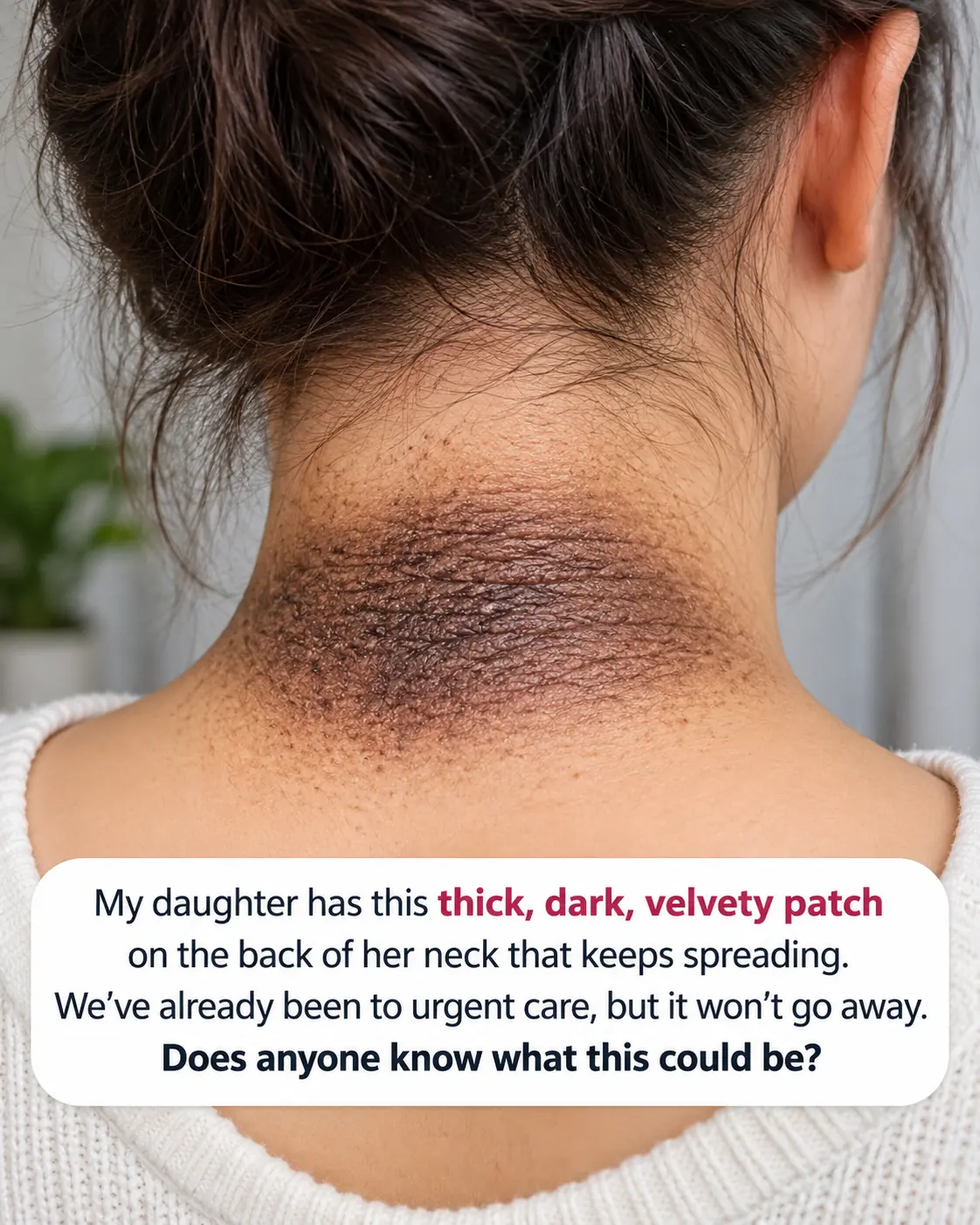 My daughter has a thick, dark, velvety patch of skin spreading across the back of her neck. It won’t wash away, and we’re hours from the nearest urgent care. What could it be?