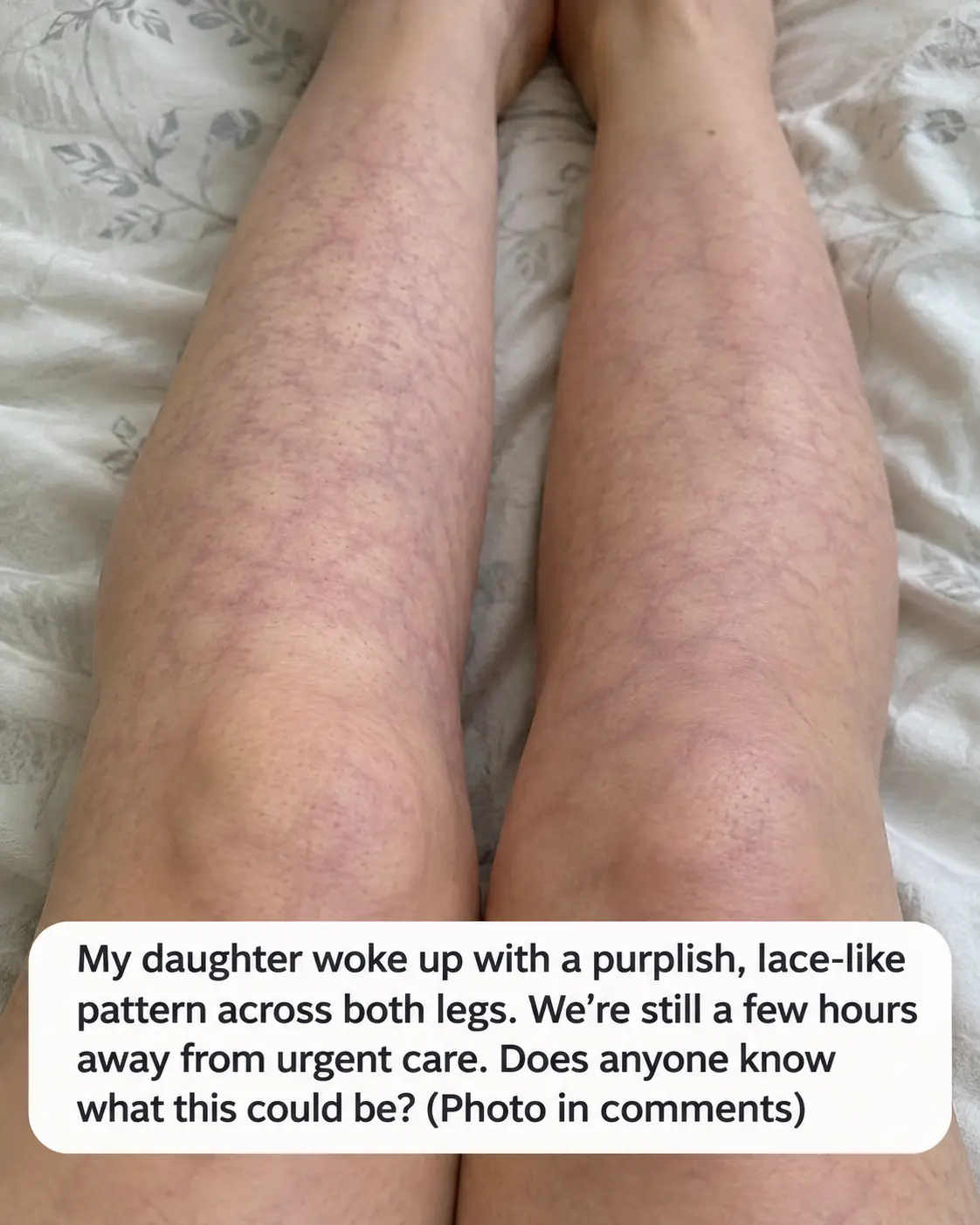 My daughter woke up with this mottled, purplish, lace-like pattern covering both her legs. We are hours from urgent care right now. What is this?